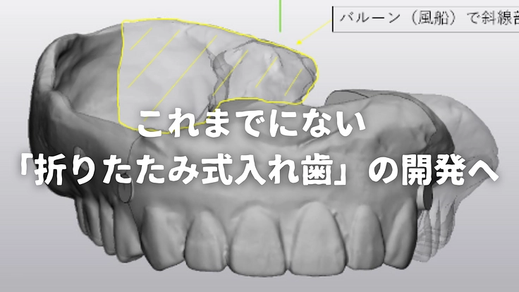 折りたたみ式入れ歯を開発し、開口障害がある方も顎義歯を使えるように 3枚目