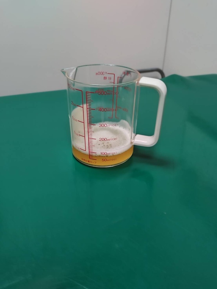 抜いた腹水の画像