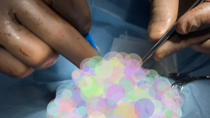 手術の写真にてモザイクしてます